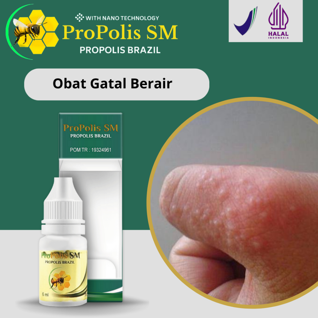 Obat Gatal Berair Di Tangan, Obat Gatal Kulit, Kulit Bintik Bintik Berair, Bintik Merah Obat Infeksi