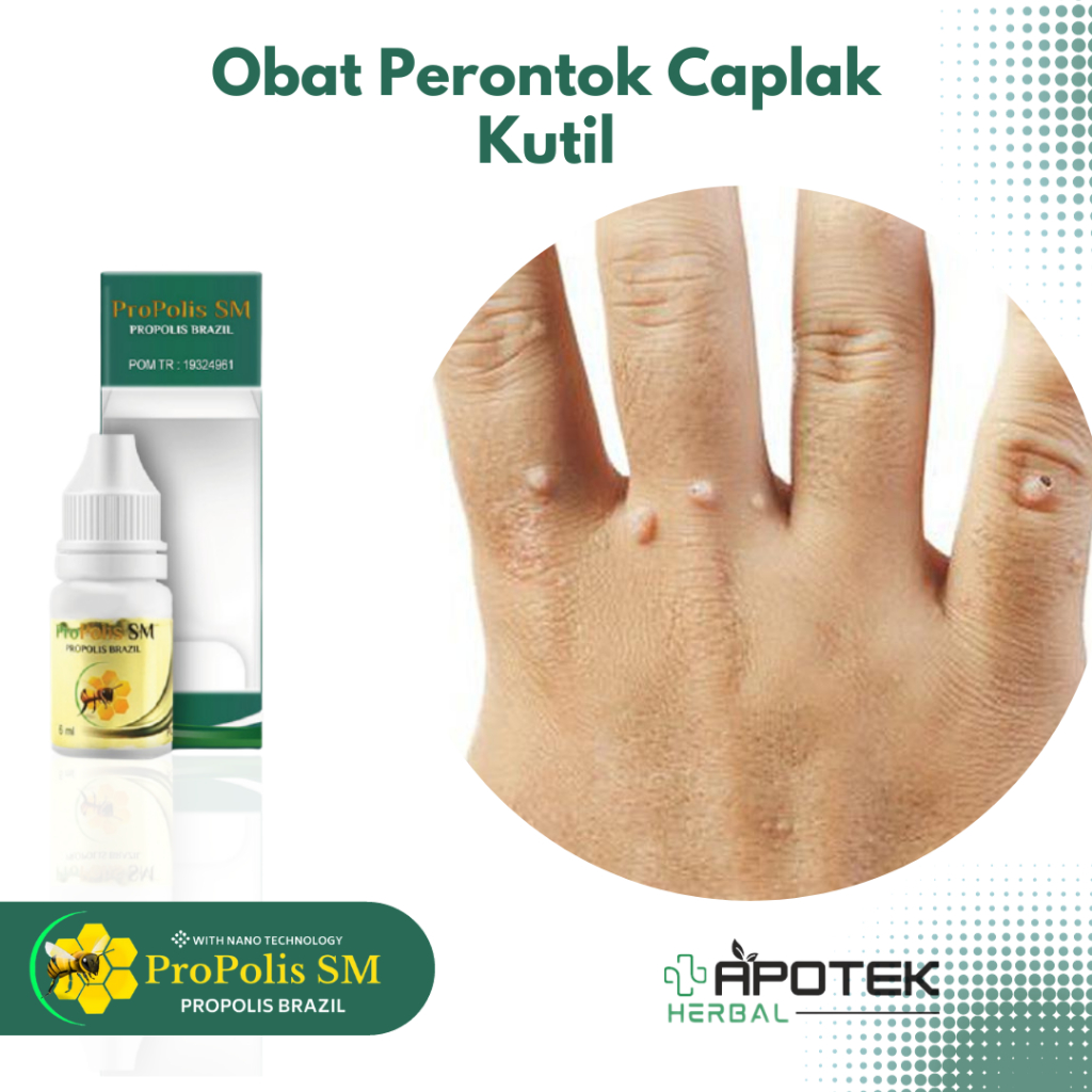 Obat Caplak Kutil, Obat Kutil di Tangan, Obat Menghilangkan Kutil, Obat Kutil di Jari Tangan, Obat O