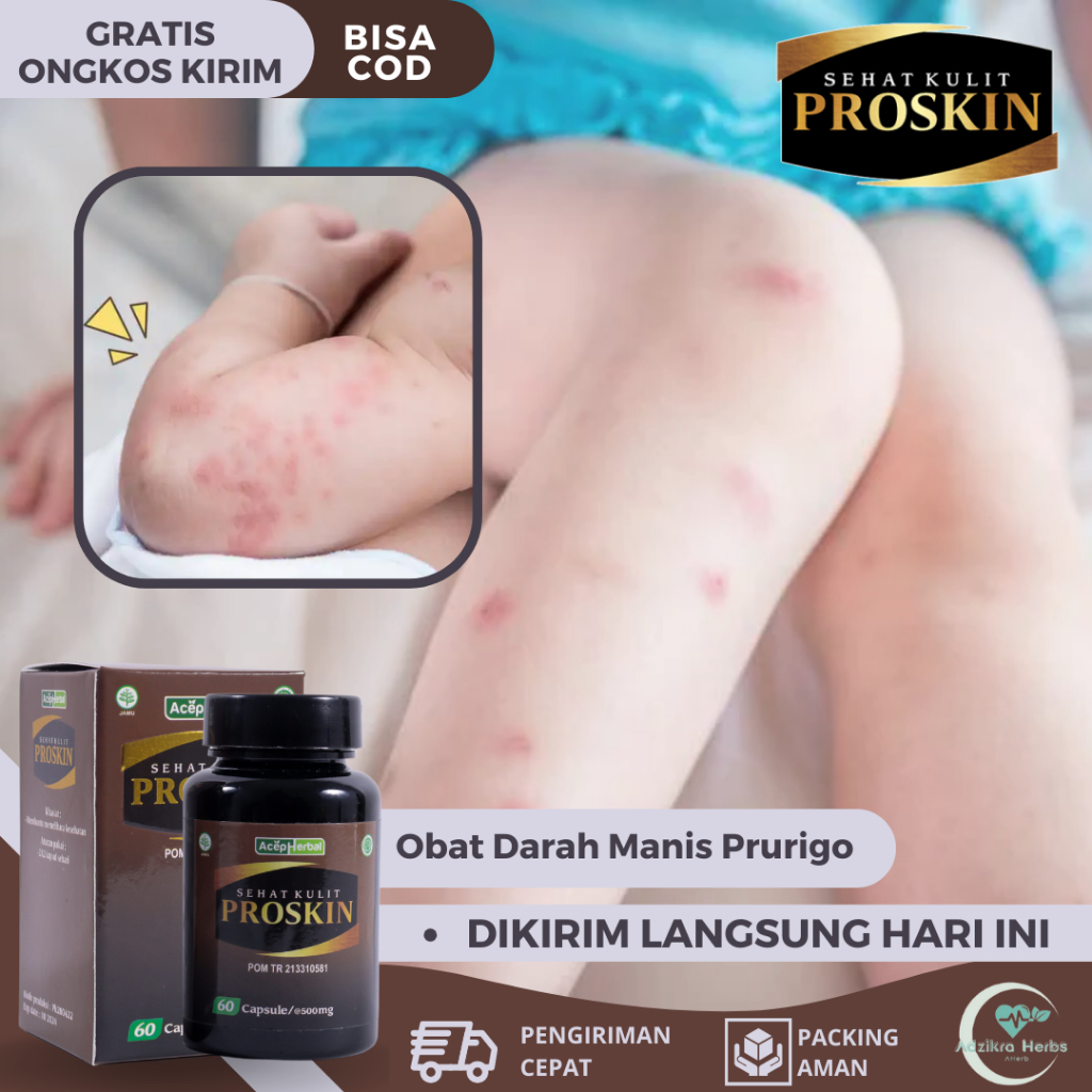 Obat Darah Manis, Obat Herbal Prurigo, Obat Budug, Obat Gatal Kulit Darah Manis, Obat Gatal Bintik B