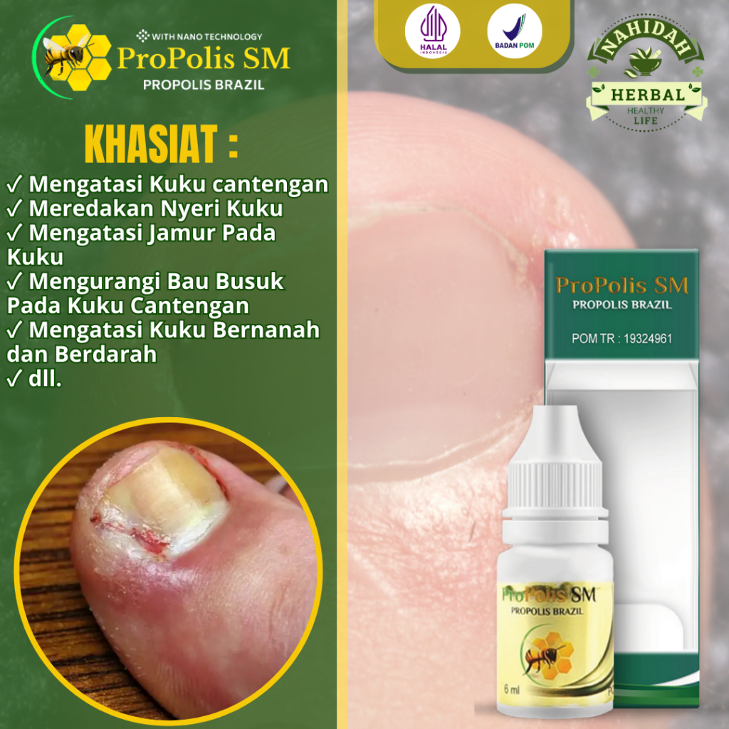 Obat Kuku Cantengan, Kuku Bau Busuk Akibat Cantengan, Obat Nyeri Kuku Bengkak, Obat Kuku Berdarah Da