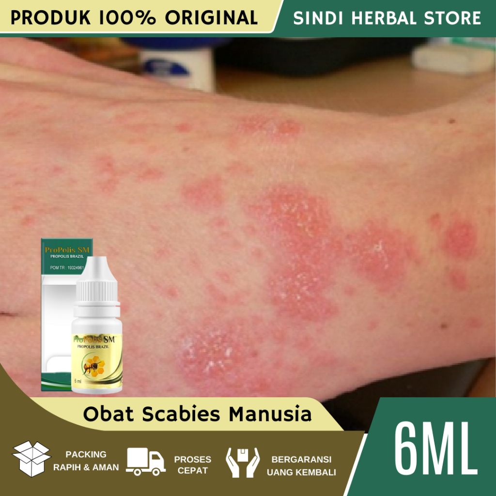 Obat Scabies Manusia, Obat Gatal Scabies Manusia, Pembasmi Kutu Sekabies Kudis Gudik Budug, Obat Gat