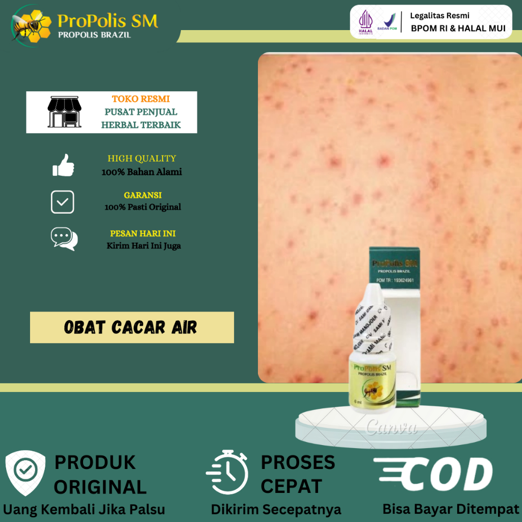 Obat Cacar Air, Obat Cacar Api, Obat Cacar Air Anak, Obat Cacar Air Dewasa, Obat Penghilang Bekas Ca