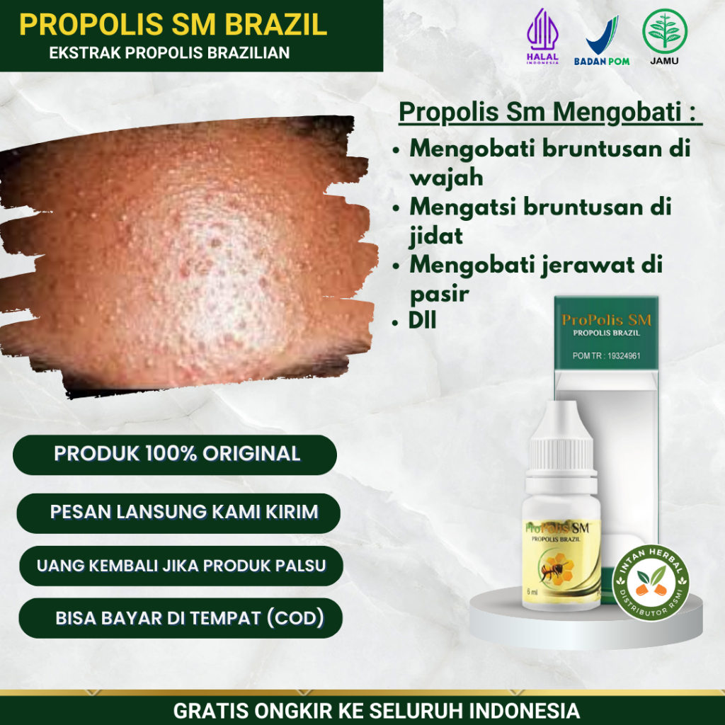 Propolis SM 100% Original - Obat Bruntusan, Bruntusan Di Wajah, Bruntusan Di Jidat, Bruntusan Parah,