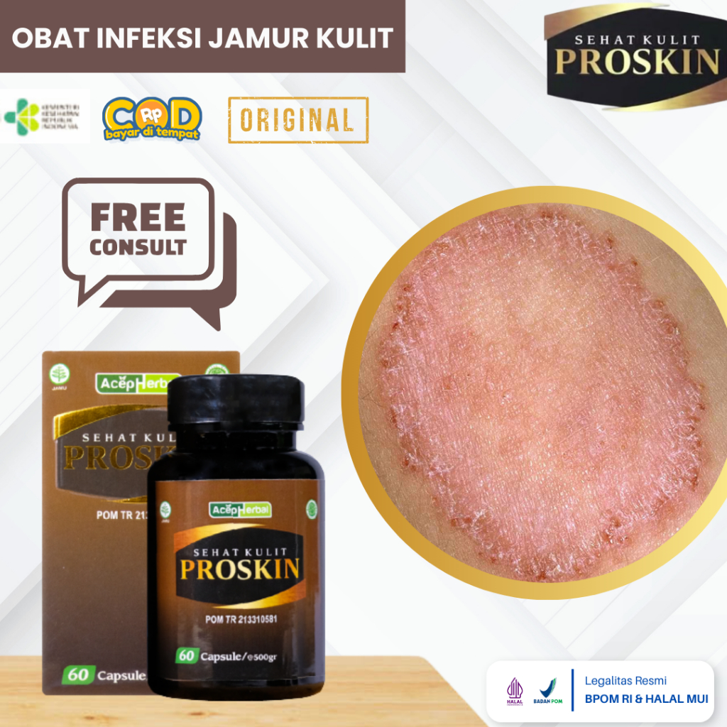 Obat Infeksi Kulit Jamur, Obat Kulit Gatal, Obat Jamur Kulit, Jamur Kurap, Obat Luka Kering Di Kulit