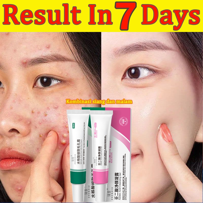 【2 pcs】Krim anti jerawat-Perawatan Jerawat Membuat Wajah Cerah Berseri-Anti flek jerawat dan komedo-