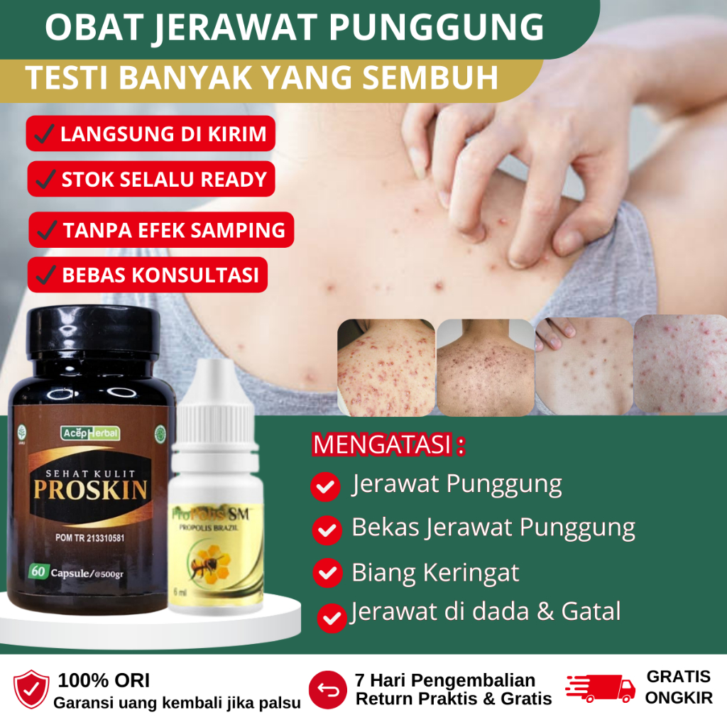 obat gatal punggung, obat jerawat Punggung dan bekas jerawat, salep jerawat punggung, Penghilang jer