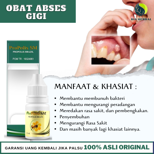 Obat Abses Gigi, Abses Periodontal, Obat Benjolan Berisi Nanah Pada Gigi Abses Gigi Akibat Infeksi B