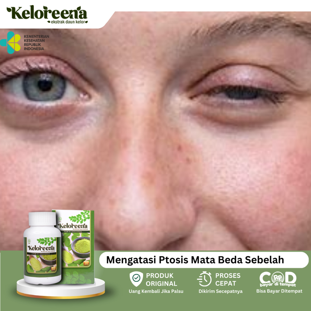 Obat Kelopak Mata Turun, Obat Ptosis, Obat Mata Turun Sebelah, Obat Mata Sipit Sebelah, Obat Mata Ma
