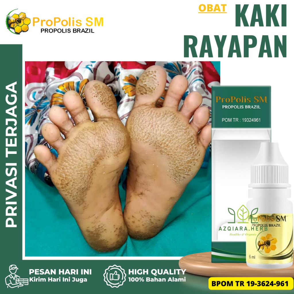 Obat Kaki Rayapan, Obat Kaki Berlubang, Obat Kaki Jamuran, Obat Telapak kaki Rusak, Obat Kaki Bolong