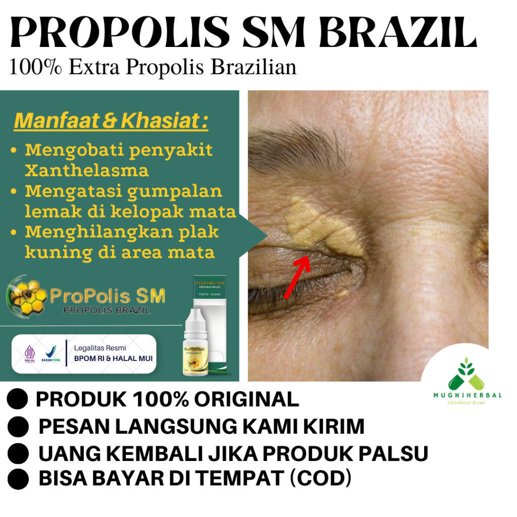 Propolis SM - Obat Xanthelasma, Herbal Mata Xanthelasma, Penghilang Xanthelasma, Flak Kuning di Sudu