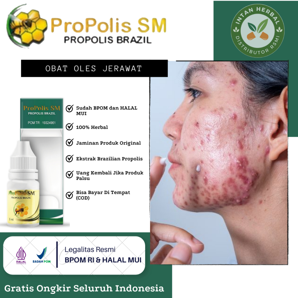 Propolis SM - Obat Oles Jerawat, Bekas Jerawat, Jerawat Batu, Jerawat di Jidat, Jerawat di Pipi, Jer