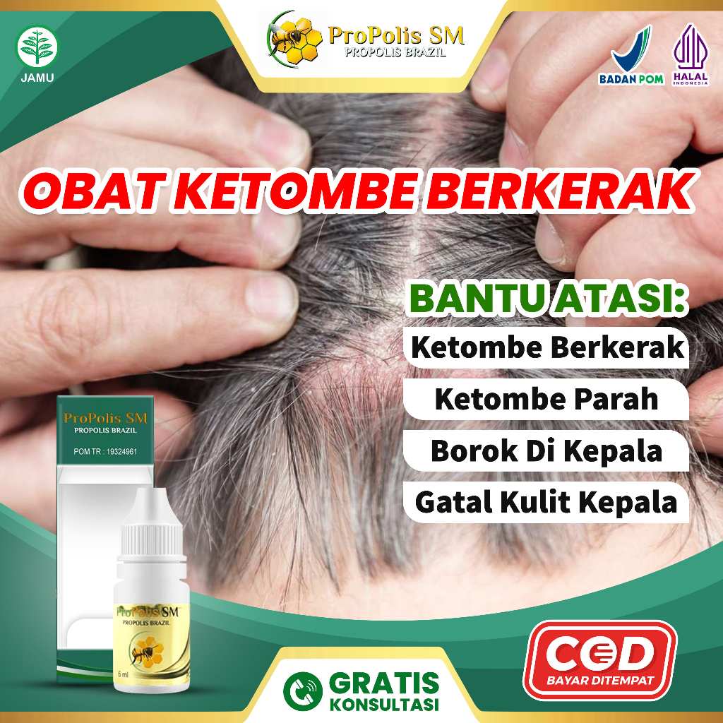 Obat Ketombe Berkerak, Psoriasis Kulit Kepala, Salep Borok Di Kepala / Koreng Kepala - Propolis SM