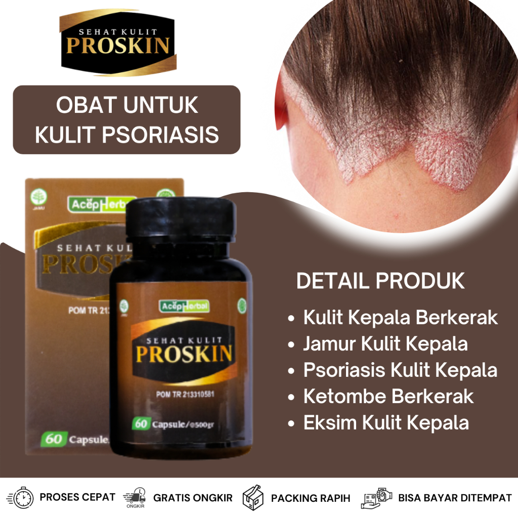 Obat Psoriasis, Obat Gatal Jamur Kulit Kepala, Obat Ketombe Basah, Obat Ketombe Berkerak, Obat Gatal