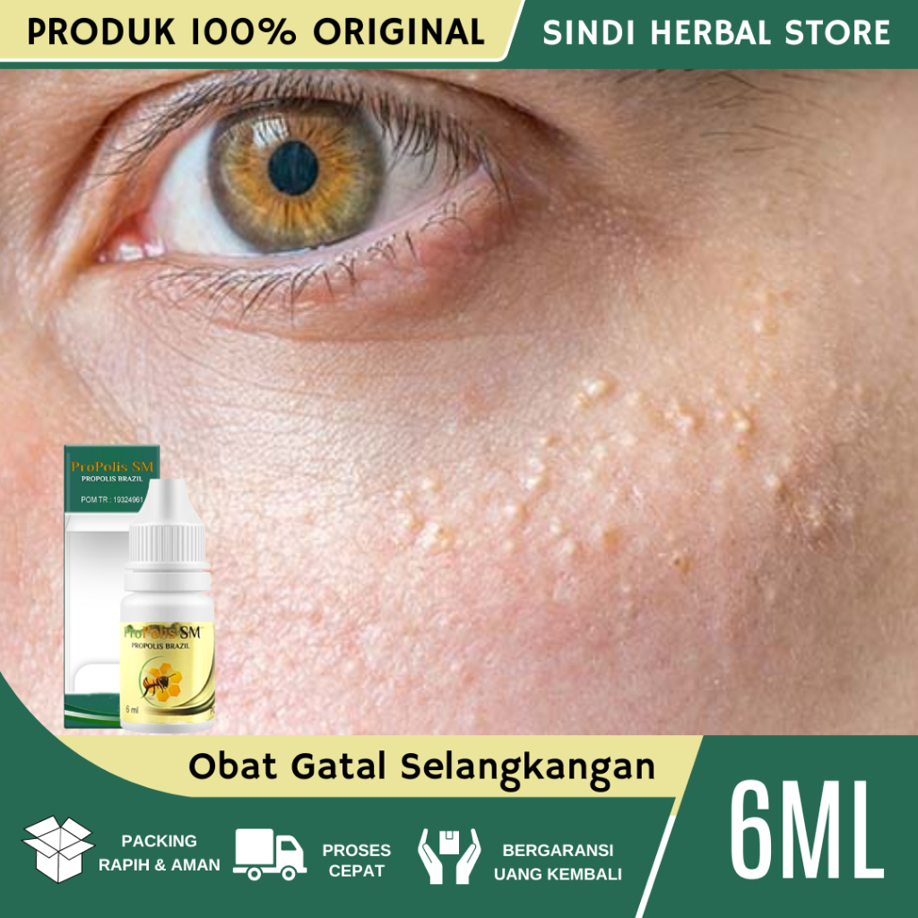 Obat Milia, Obat Buat Ngilangin Milia, Penghilang Bintik Putih Milia di Bawah Mata, Penghilang Milia