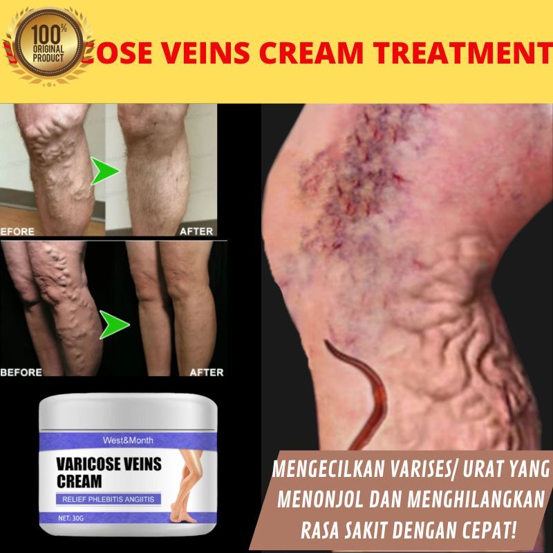 Varicose Veins Cream 100% Ampuh atasi varises