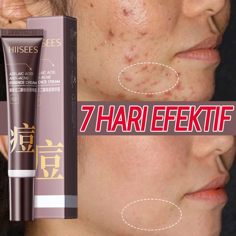 Krim Penghilang Jerawat dan Bekas Jerawat Cream Jerawat Menghilangkan Jerawat Bruntusan Ampuh  Cepat