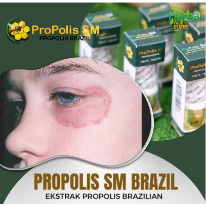 Obat Penghilang Gatel - Gatal Merah Melingkar akibat jamur di wajah, selangkangan,leher,kaki,kepala,