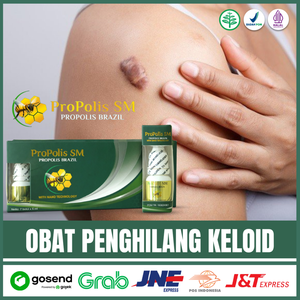 Obat Penghilang Keloid,Keloid Bekas Luka,Obat Keloid Bekas Operasi Daging Tumbuh Propolis Sm Brazil