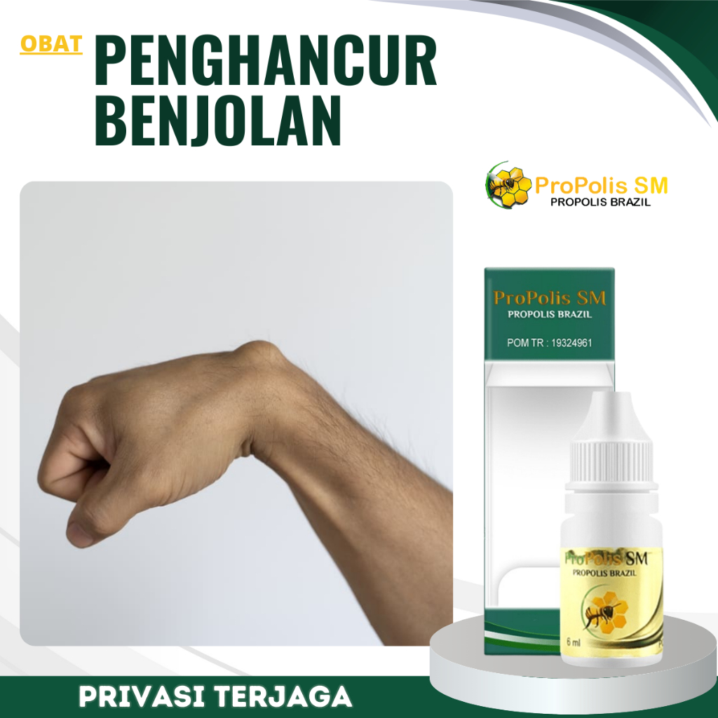 Obat Penghancur Benjolan, Obat Oles Pengempis Benjolan Di Tangan, Obat Benjolan Punggung, Obat Benjo