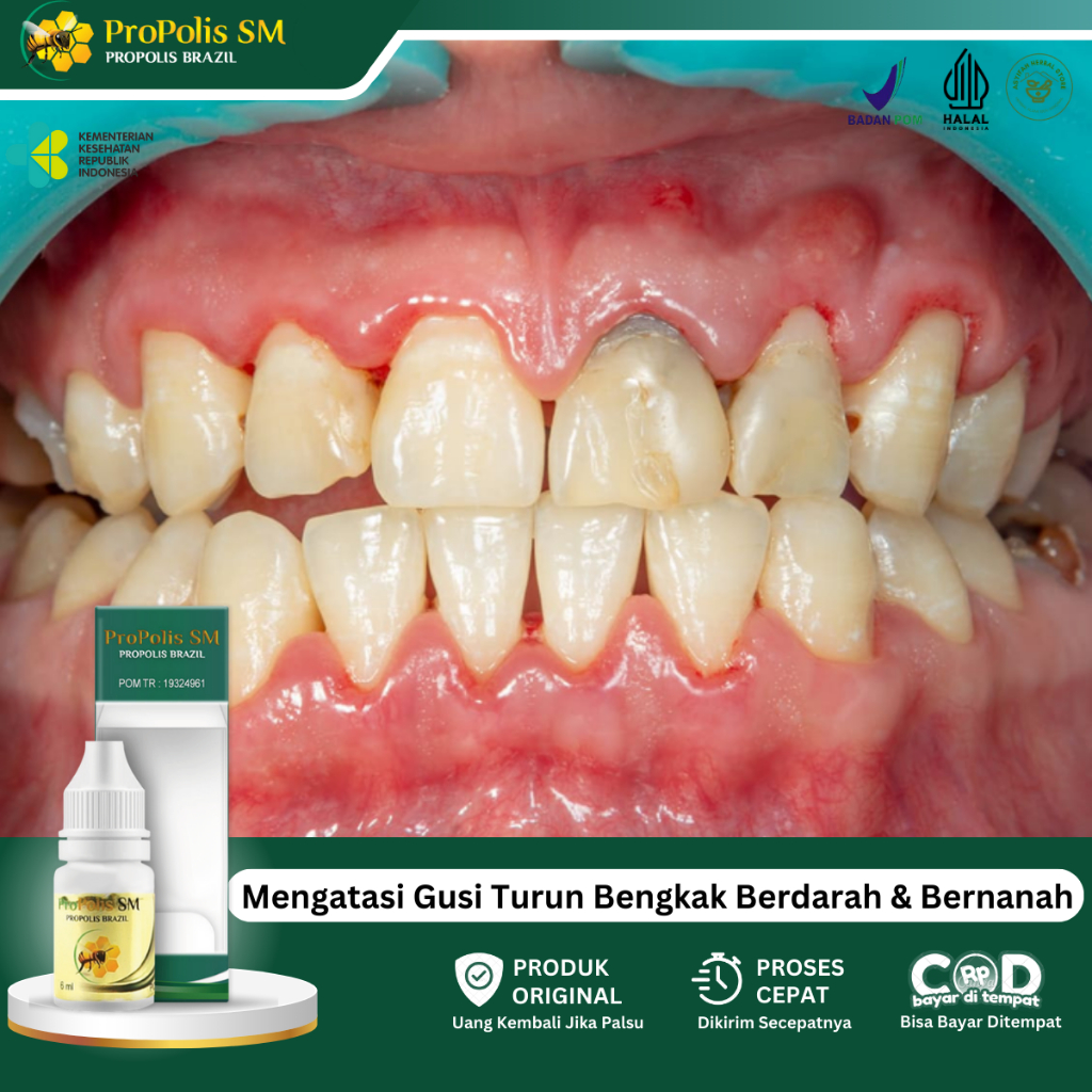 Obat Gusi Turun, Obat Gusi Menyusut, Obat Nyeri Gusi, Obat Gusi Bengkak, Obat Nyeri Gusi, Obat Reses