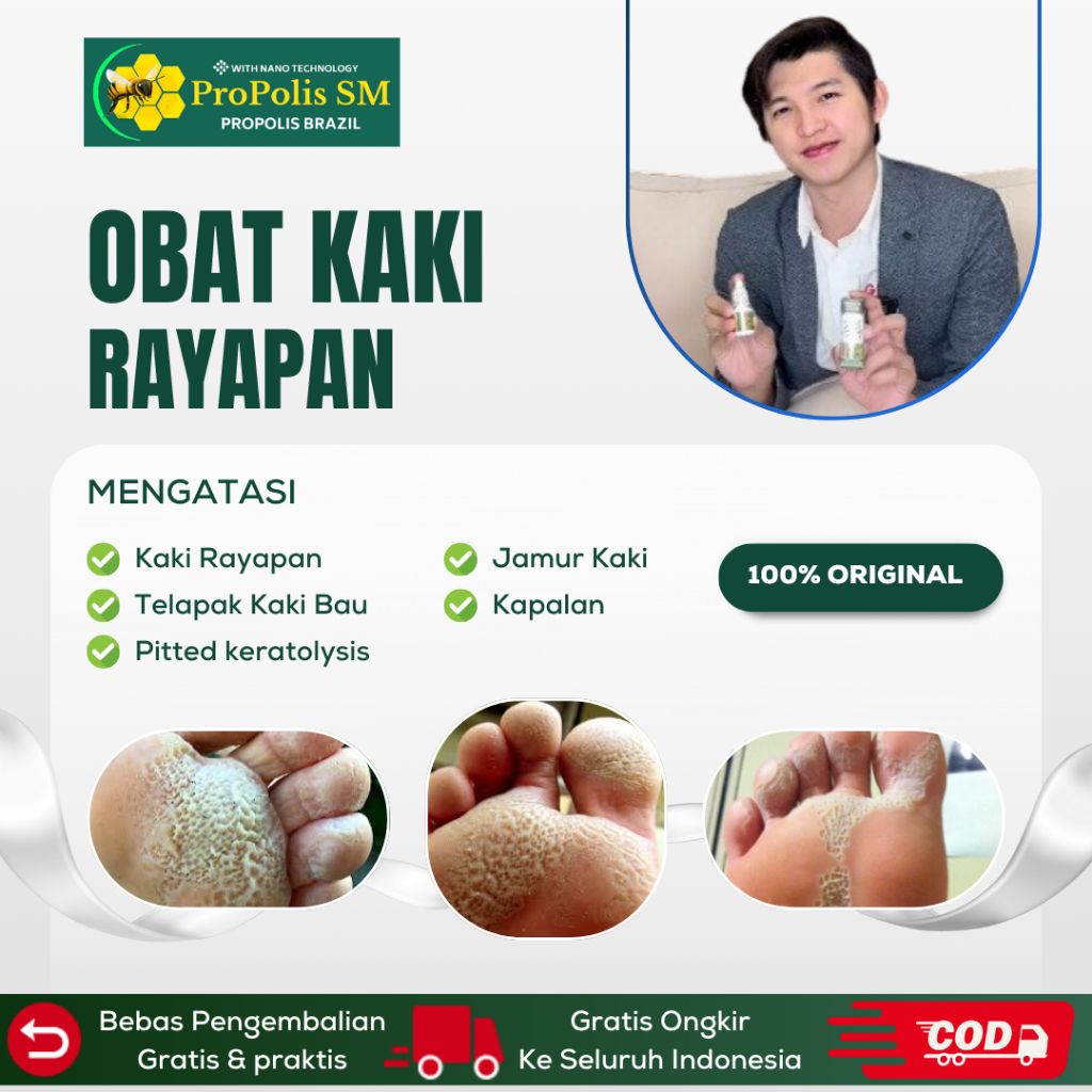 Obat Kaki Rayapan - Obat Kaki Rayap Dan Bau - Obat Telapak Kaki Rayapan - Telapak Kaki Berlubang - B
