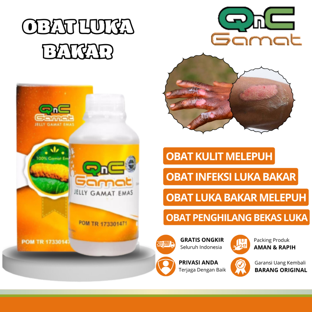 Obat Luka Bakar, Obat Luka Bakar Kulit Melepuh, Obat Luka Bakar Berair, Obat Luka Bakar Melepuh, Oba