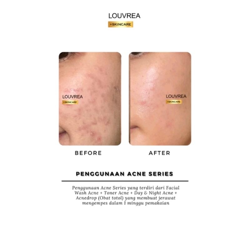 Louvrea Toner Acne/Louvrea Toner jerawat