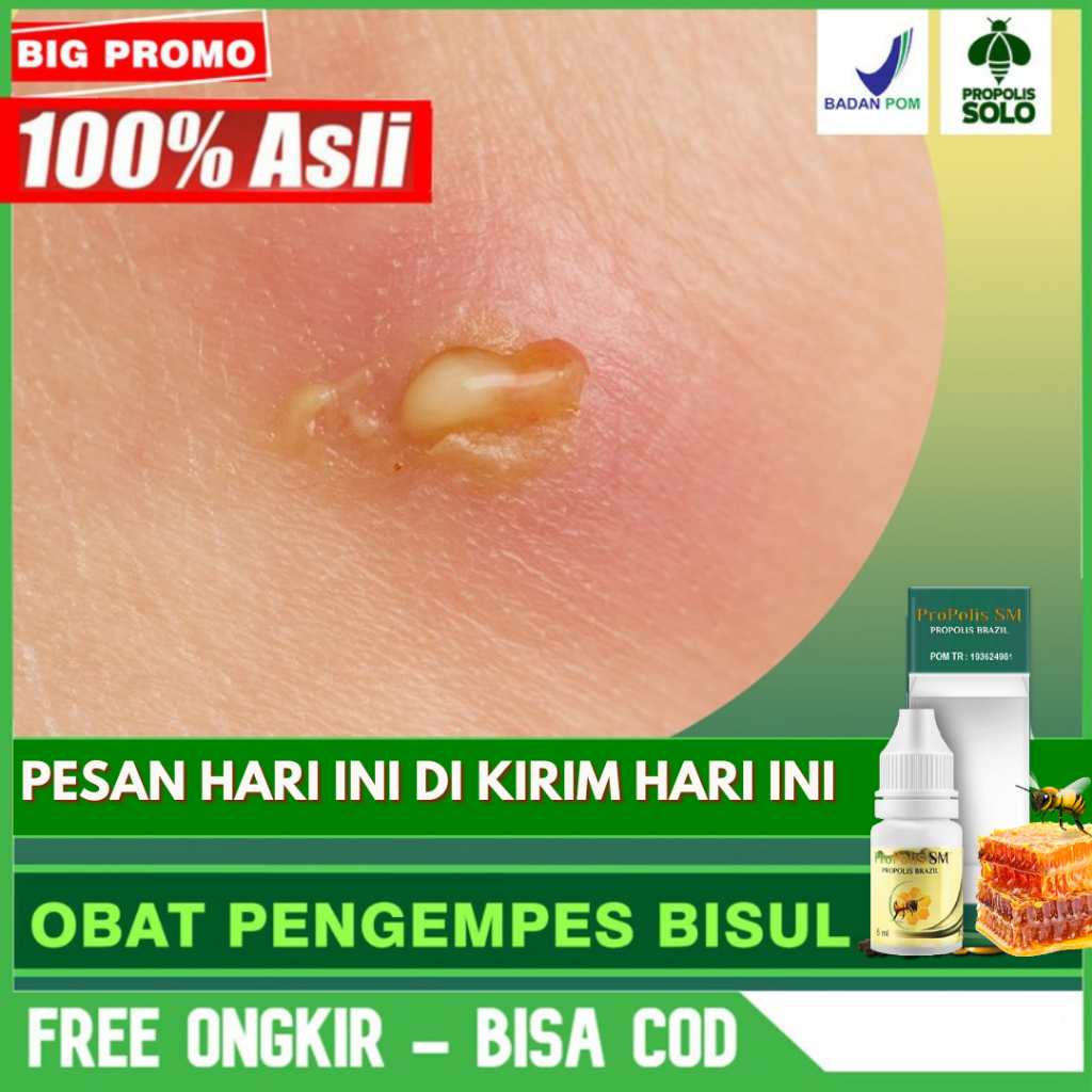 

Obat Pengempes Bisul Bisulan - Bisul Di Paha Tangan Kaki Herbal Propolis SM Brazil Bisa COD di SOLO