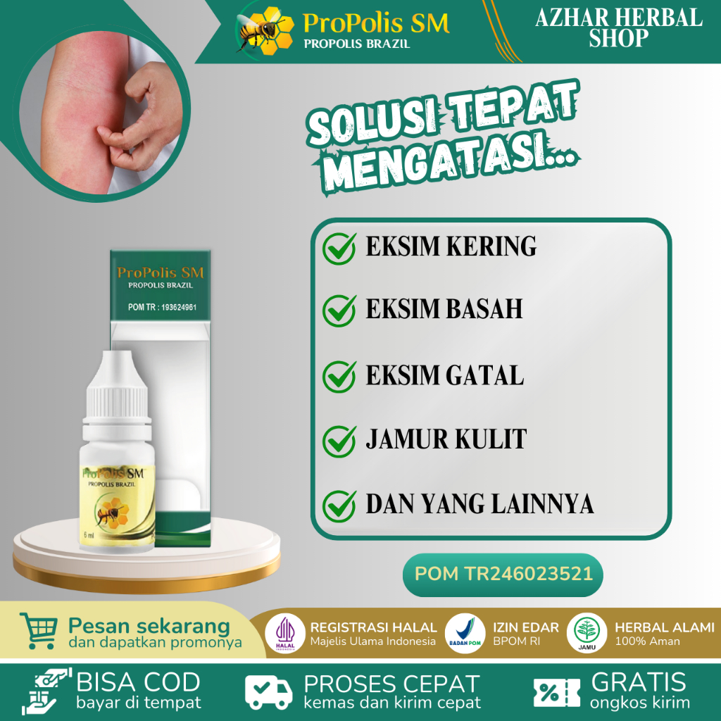 Propolis SM Obat Eksim Kering Menahun, Obat Eksim Gatal, Obat Eksim Basah, Eksim Di Selangkangan