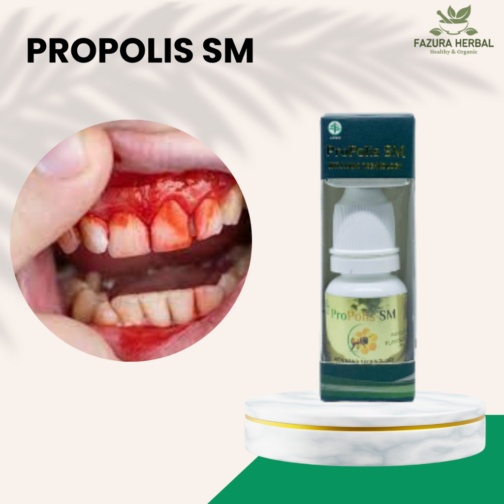 Obat Gusi Berdarah, Obat Gusi Bernanah, Obat Gusi Bengkak, Obat Sakit Gusi, Obat Infeksi Pada Gusi, 