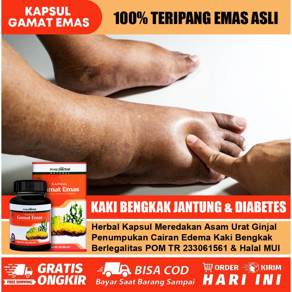 Obat Kaki Bengkak Karena Jantung Diabetes, Asam Urat Ginjal Penumpukan Cairan Edema Dgn Kapsul Gamat