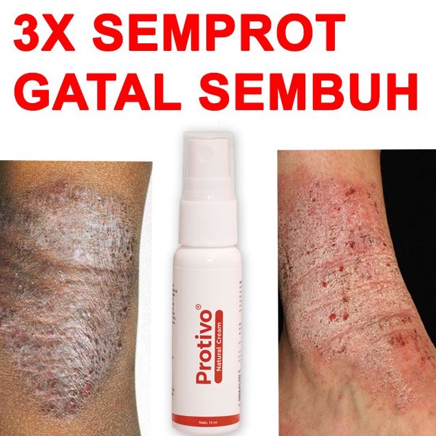 Protivo Natural Cream  Obat Gatal  Salep Gatal  Cream Gatal  Obat Kulit Gatal  Obat Gatal Menahun  O