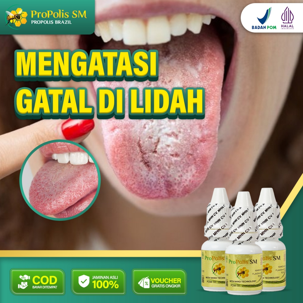 obat gatal lidah propolis sm,obat lidah gatal,Lidah Berjamur, Lidah Pecah Pecah,propolis sm di surab