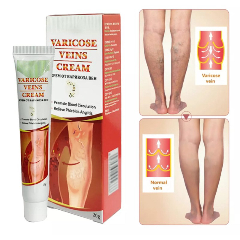 Cream Varises/Spider Veins