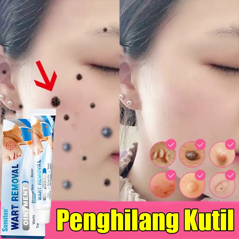 Obat kutil Penghilang kutil di wajah Penghilang tahi lalat Salep kutil Obat penghilang kutil paling 