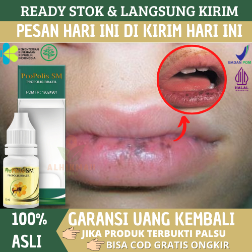 Propolis SM - Obat Herbal Penghilang Bintik Hitam Di Bibir Karena Alergi / Iritasi Kosmetik, Bibir T