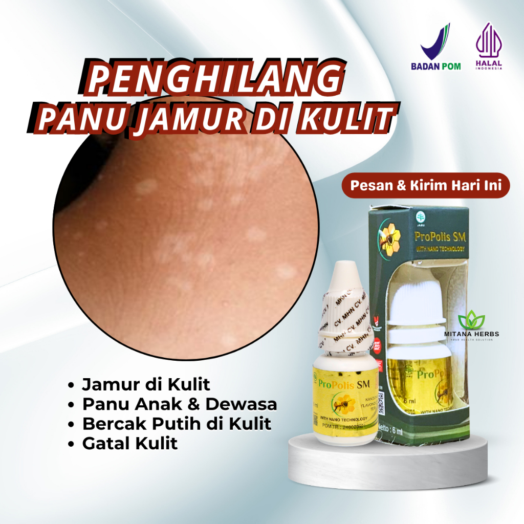Obat Hapur Kulit, Obat Panu, Obat Jamur Kulit, Obat Panu Cair Penghilang Panu Kadas Anak dan Dewasa