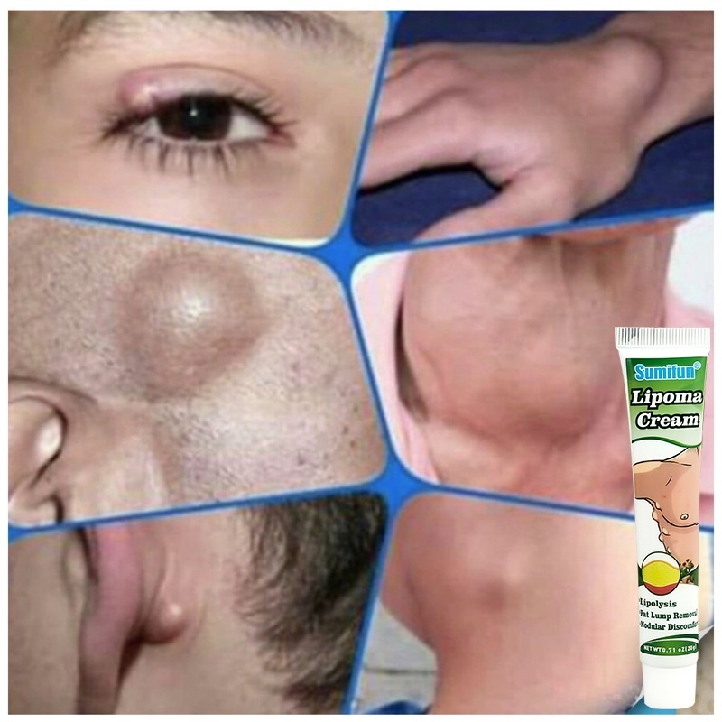 𝗢𝗥𝗜𝗚𝗜𝗡𝗔𝗟 𝗦𝗨𝗠𝗜𝗙𝗨𝗡 Obat Benjolan lipoma cream original Lipoma OBAT OLES PENGHILANG BENJOLAN LIPOMA 20g