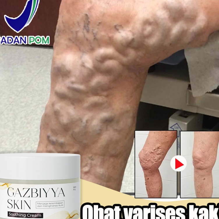 BPOM Obat varises di kaki dan betis paling ampuh Obat varises Salep varises 3g Valesin obat varises 