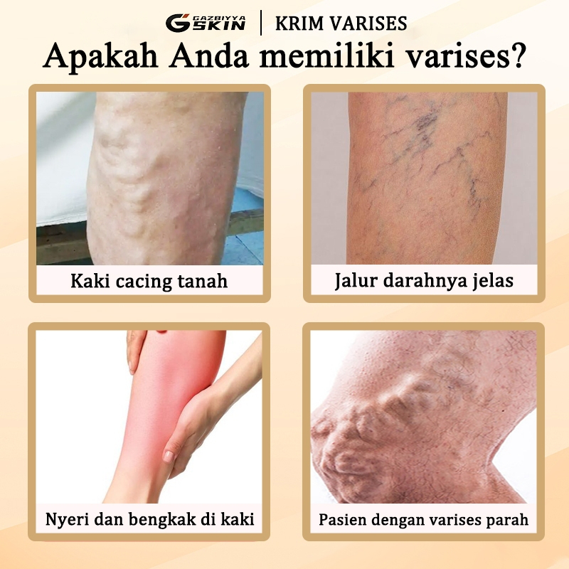 Cream varises paling ampuh original salep varises obat varises salep 30g varises salep laba-laba