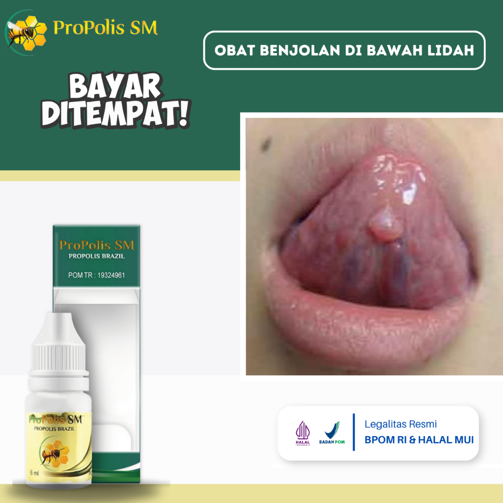 Obat Benjolan Di Lidah, Obat Benjolan Di Bawah Lidah, Obat Benjolan Dilidah Anak Dan Dewasa, Obat Ke