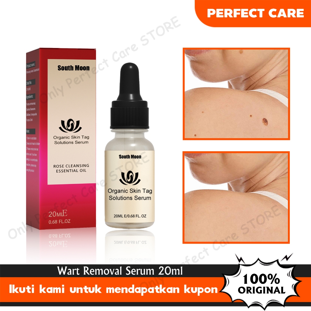 EELHOE Wart Removal Serum 20ml Penghilang Tahi Lalat Skin Tag Remover Penghilang Kutil Tahi Lalat