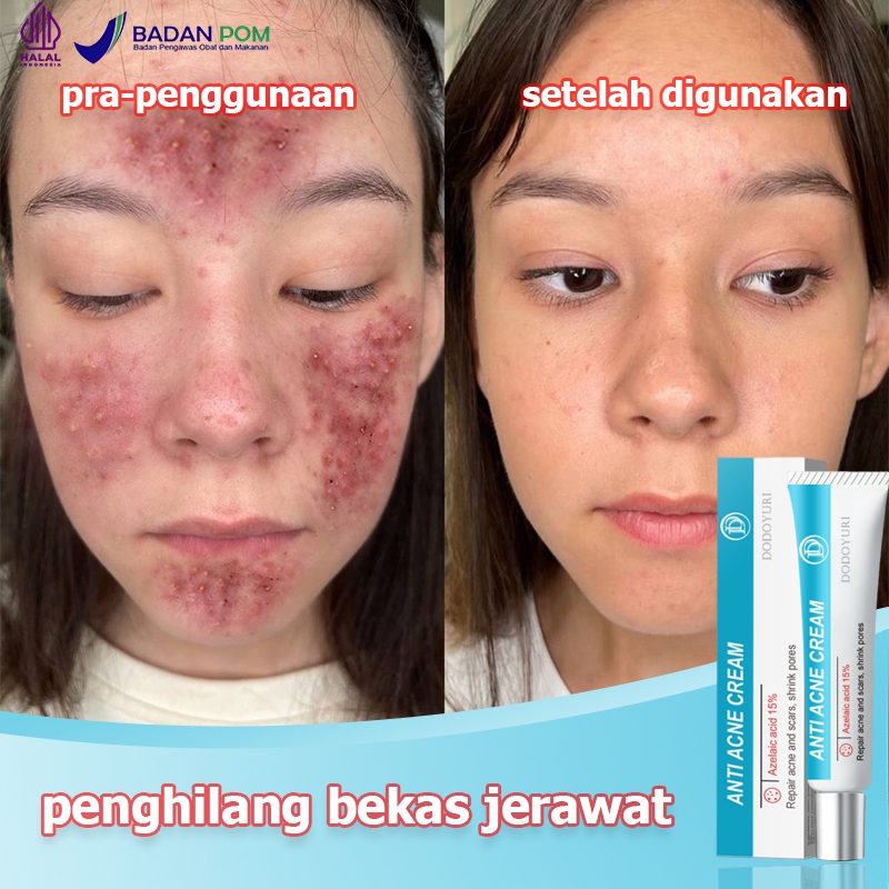 Salep jerawat Menghilangkan bekas jerawat Obat totol jerawat Penghilang bekas jerawat Obat jerawat 2