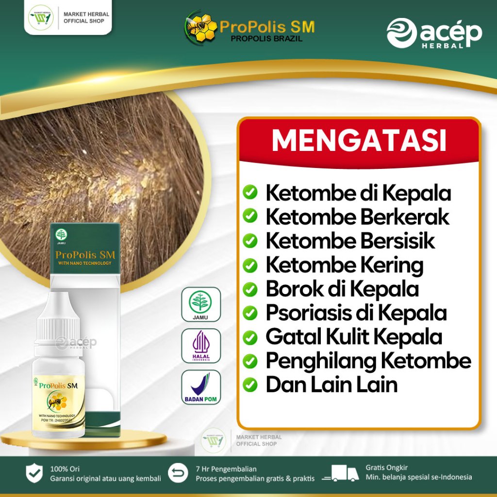 Obat Penghilang Ketombe Di Kepala, Borok di Kepala, Psoriasis di Kepala, Luka di Kepala, Benjolan Di