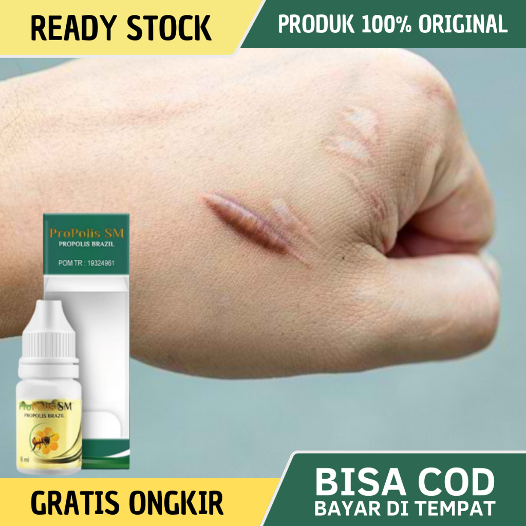 Obat Keloid, Obat Keloid Daging Tumbuh, Obat Keloid Menahun, Obat Keloid Bekas Luka, Obat Keloid Bek
