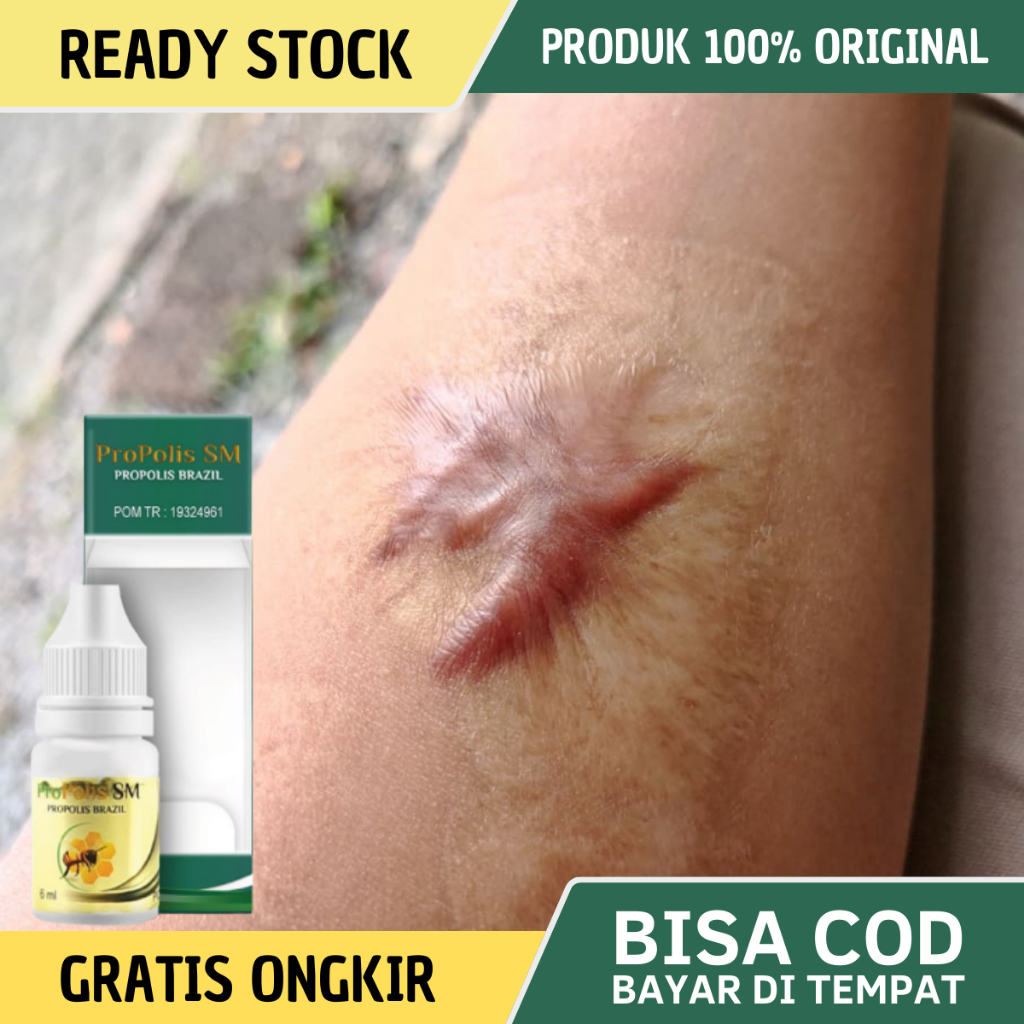 Obat Keloid, Obat Keloid Menahun, Obat Daging Tumbuh, Obat Daging Jadi, Obat keloid Luka Tindik, Oba