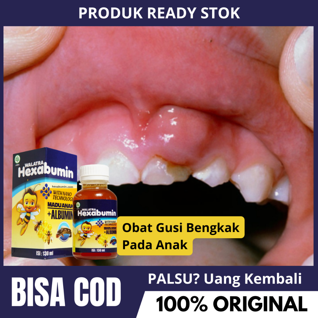 Obat Gusi Bengkak Anak, Radang Gusi Anak, Nyeri Gusi Anak, Obat Sakit Gigi Anak - Hexabumin Madu Ori