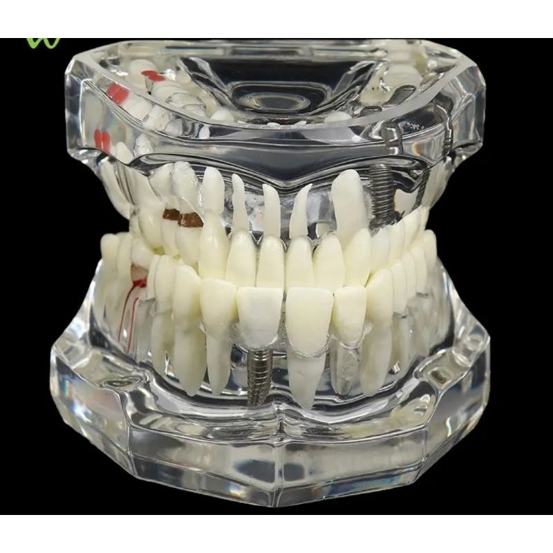 Dental model study gigi edukasi transparan study implant phantom crown caries bridge