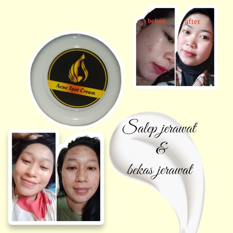IV GLOW Salep Magic Penghilang Jerawat/salep jerawat/salep acne/cream jerawat/cream jerawat ampuh