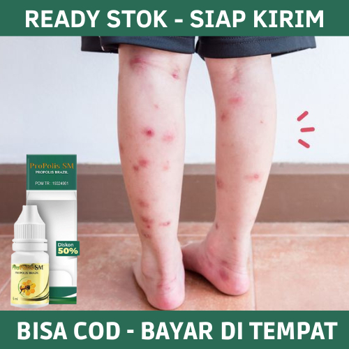Obat Darah Manis, Obat Darah Manis Dan Bekas Luka, Obat Darah Manis Anak Dan Dewasa, Obat Gatal Kuli